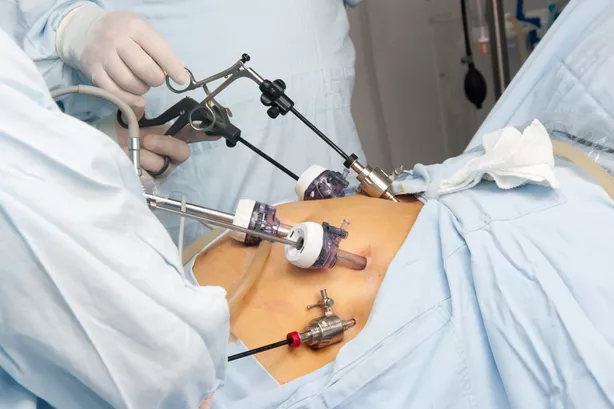 جراحی چاقی معده جراحی لاغری انواع عمل جراحی چاقی معده 