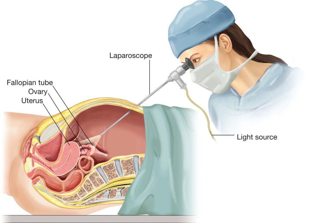 جراحی لاپاروسکوپی معده لاپاراسکوپی چیست؟ 