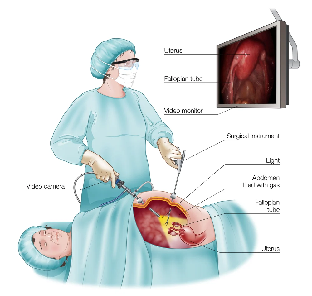 انواع جراحی چاقی - روش های جراحی لاغری - جراحی لاپاراسکوپی