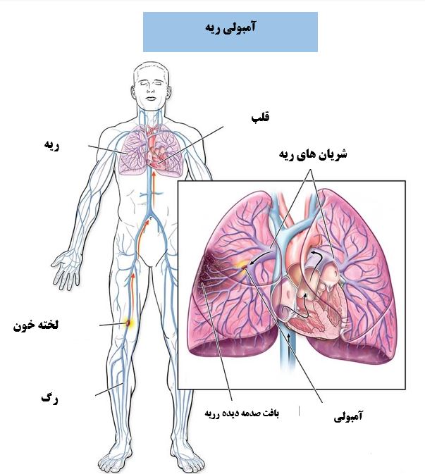 خطر آمبولی تا چند روز بعد از عمل اسلیو است