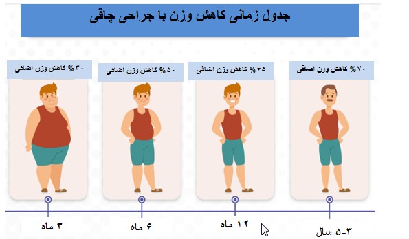 بعد از عمل اسلیو چقدر باید راه رفت+بوتاکس معده چگونه است+بوتاکس معده برای چه وزنی مناسب است+کدام عمل لاغری بدون بازگشت است