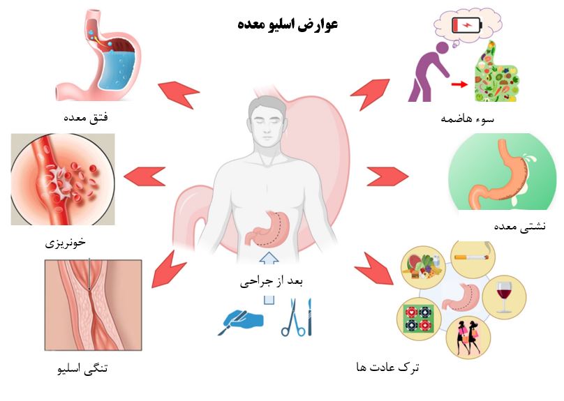 خطر آمبولی تا چند روز بعد از عمل اسلیو است