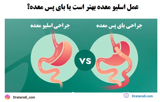 آیا بعد از اسلیو معده گشاد می‌شود+دوره نقاهت لیپوماتیک چقدر است+چه قرصی معده را کوچک می‌کند+بوتاکس معده برای چه وزنی است