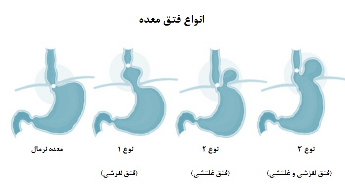 همه چیز درباره فتق معده و علائم آن
