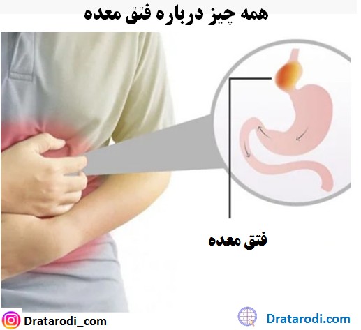همه چیز درباره فتق معده و علائم آن